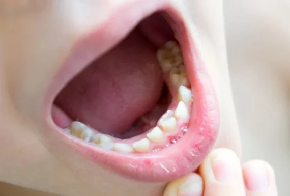Pediatric Root Canals and Fillings