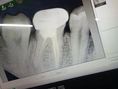 Rvg(Dental X-ray)